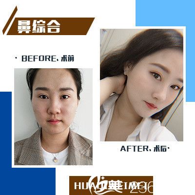 東莞維多利亞醫(yī)院隆鼻效果圖 東莞維多利亞醫(yī)院隆鼻效果圖