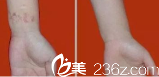 北京米蘭柏羽麗都去疤實(shí)例參考