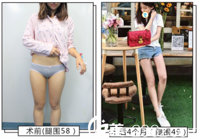 成都艾米麗大腿吸脂術(shù)后4個月對比 成都艾米麗大腿吸脂術(shù)后4個月對比