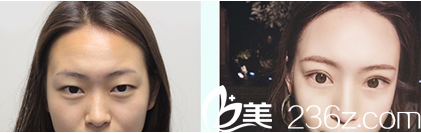 成都艾米麗雙眼皮手術(shù)前后對比 成都艾米麗雙眼皮手術(shù)前后對比