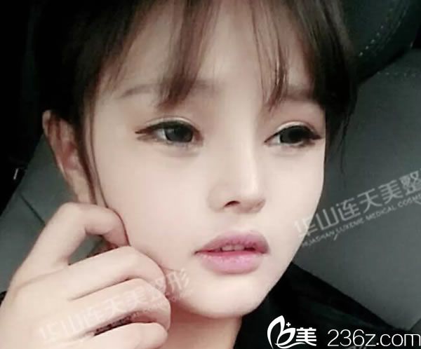 做完半肋鼻綜合隆鼻手術后 做完半肋鼻綜合隆鼻手術后