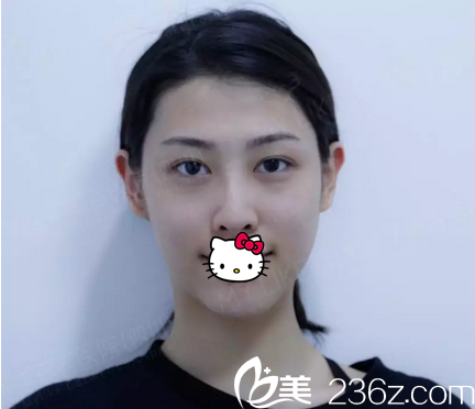 自體脂肪面部填充術(shù)前照 自體脂肪面部填充術(shù)前照