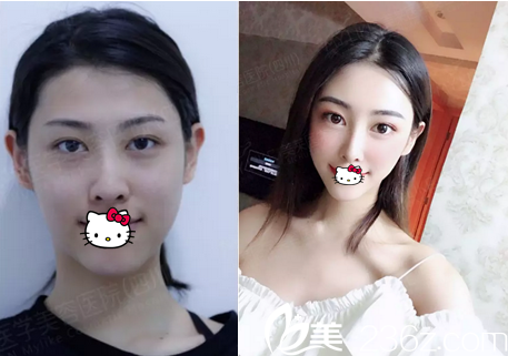 四川美萊熊猛采用新品長效脂肪膠給做的自體脂肪面部填充案例效果分享 