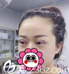 剛做完雙眼皮腫脹感比較強