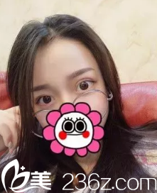 術(shù)后7天拆線后雙眼皮微腫