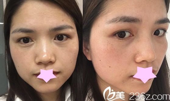 去合肥華美整形做皮秒祛斑前照片 去合肥華美整形做皮秒祛斑前照片