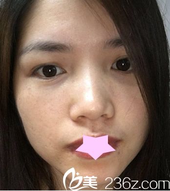 合肥華美超皮秒祛斑后第9天照片 合肥華美超皮秒祛斑后第9天照片