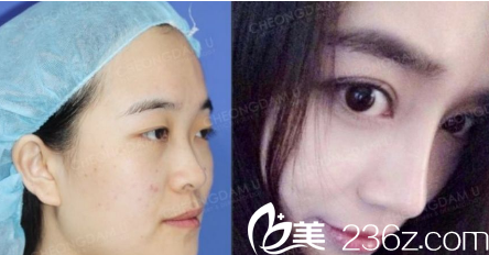 全肋骨隆鼻修復(fù)案例一