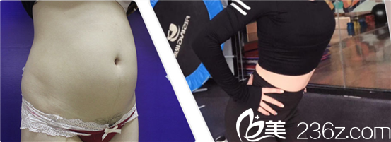 成都市西區(qū)醫(yī)院毛健清腰腹吸脂案例 成都市西區(qū)醫(yī)院毛健清腰腹吸脂案例