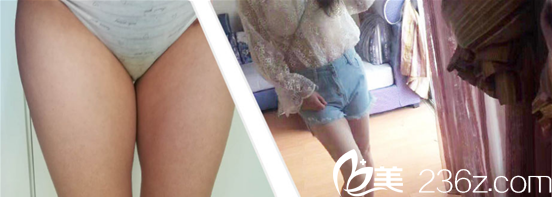 毛健清大腿吸脂案例效果分享 毛健清大腿吸脂案例效果分享