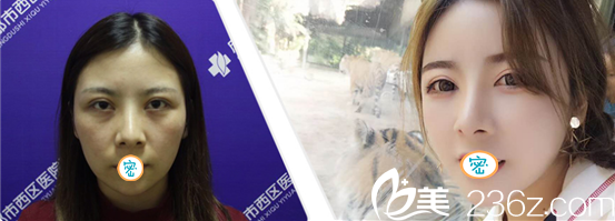 毛建清脂肪填充面部術(shù)后反饋 毛建清脂肪填充面部術(shù)后反饋