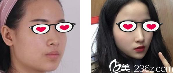 酒泉華美鼻綜合隆鼻前后對比圖