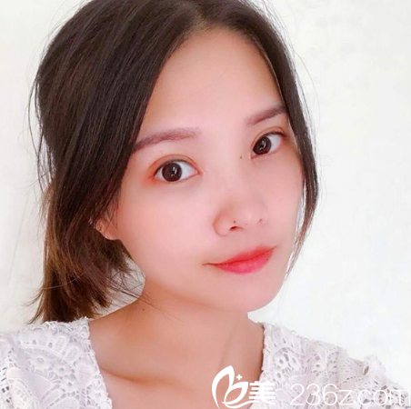 在廣州天姿整形醫(yī)院做完雙眼皮一個月自拍