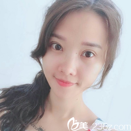 看到閨蜜找廣州天姿整形醫(yī)院院長做的雙眼皮后我也心動(dòng)了