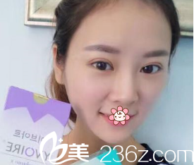 新疆黎美整形做雙眼皮怎么樣