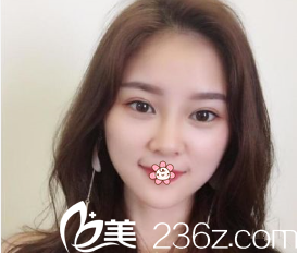 許黎做雙眼皮效果怎么樣