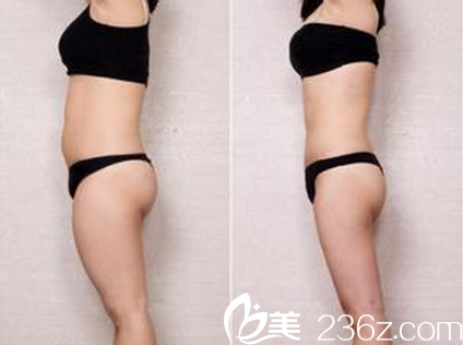 成都西區(qū)醫(yī)院全身吸脂案例對比照
