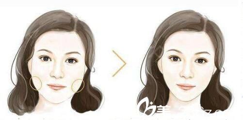 打瘦臉安全嗎？