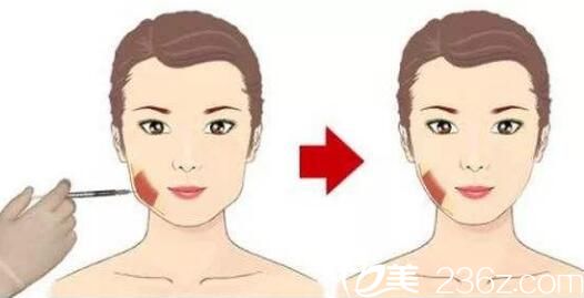 瘦臉的適應(yīng)癥