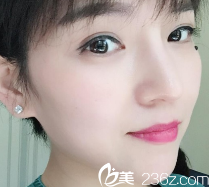 西安同安濟醫(yī)院整形科做假體隆鼻手術怎么樣？我們通過案例來了解效果