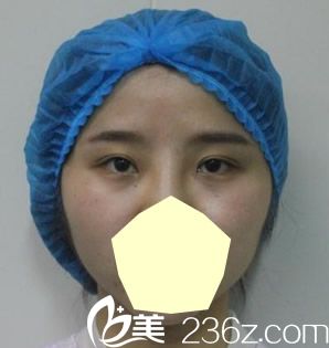 去合肥壹加壹找孟松做埋線雙眼皮失敗未修復(fù)前的樣子 去合肥壹加壹找孟松做埋線雙眼皮失敗未修復(fù)前的樣子