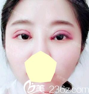 孟松給我做眼部失敗修復(fù)術(shù)后第1天恢復(fù)情況 孟松給我做眼部失敗修復(fù)術(shù)后第1天恢復(fù)情況