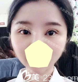 合肥壹加壹雙眼皮失敗修復(fù)術(shù)后第5天恢復(fù)效果 合肥壹加壹雙眼皮失敗修復(fù)術(shù)后第5天恢復(fù)效果