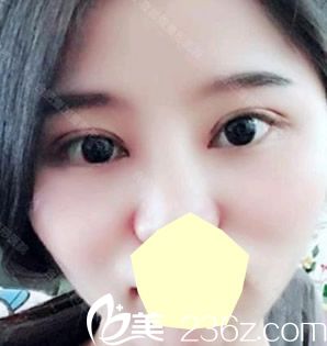 壹加壹孟松修復(fù)失敗雙眼皮術(shù)后第7天效果圖 壹加壹孟松修復(fù)失敗雙眼皮術(shù)后第7天效果圖