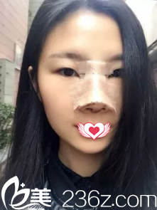 剛做完鼻子腫脹厲害