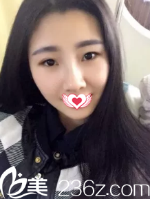 術后7天鼻子拆線后微腫