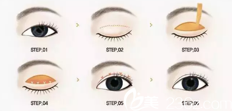 全切雙眼皮過(guò)程示意圖