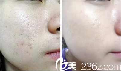 果酸換膚效果對(duì)比