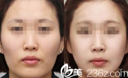 南京維多利亞自體脂肪面部填充案例對比圖