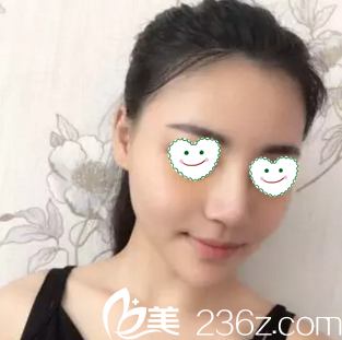 做鼻綜合術后一周拆線<span style=