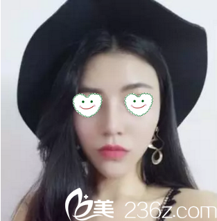 大連新華美天整形醫(yī)院做隆鼻怎么樣？看我做的鼻綜合術(shù)后30天恢復效果就知道了