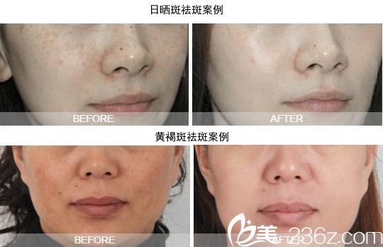 成都艾米麗真實祛斑案例 成都艾米麗真實祛斑案例