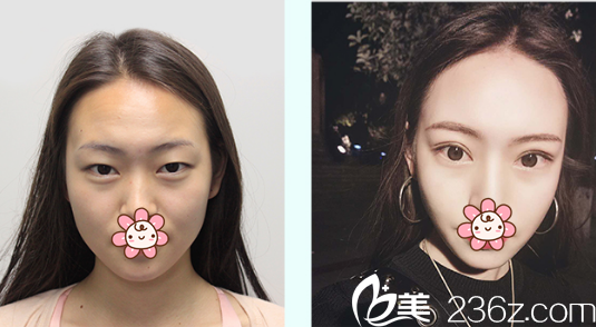 成都艾米麗孫歡雙眼皮案例效果展示