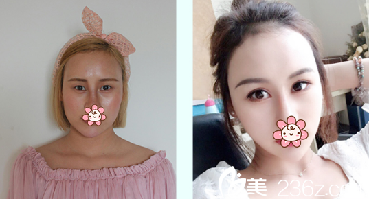 孫歡雙眼皮+開外眼角術(shù)前術(shù)后對比照片