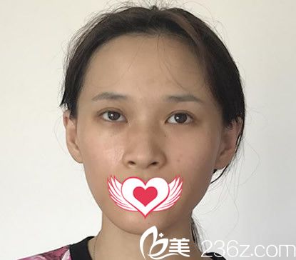 沒有去合肥臺美麗格整形穆威做鼻綜合隆鼻前樣子 沒有去合肥臺美麗格整形穆威做鼻綜合隆鼻前樣子