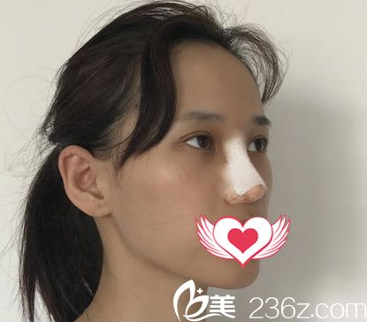 在合肥臺美麗格整形做鼻綜合術(shù)后即刻照片 在合肥臺美麗格整形做鼻綜合術(shù)后即刻照片