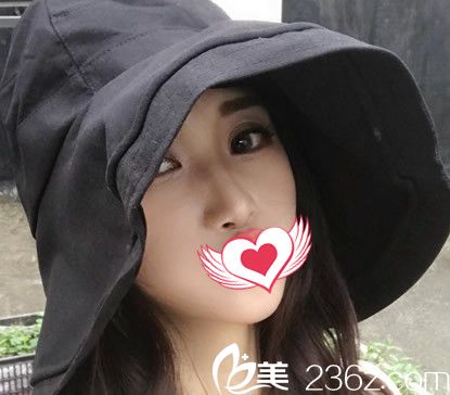 合肥臺美麗格整形假體隆鼻鼻綜合術(shù)后第7天恢復(fù)情況 合肥臺美麗格整形假體隆鼻鼻綜合術(shù)后第7天恢復(fù)情況