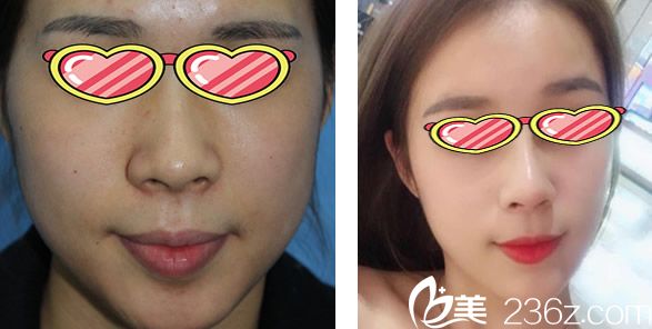 酒泉華美自體脂肪填充全臉前后效果對(duì)比