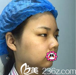 在<!--<i data=20240703-sp></i>-->做雙眼皮隆鼻前樣子 在<!--<i data=20240703-sp></i>-->做雙眼皮隆鼻前樣子