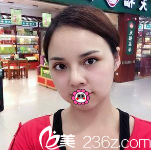 我在看切開雙眼皮+硅膠假體隆鼻案例效果還不錯就決定找趙京玉做了改善