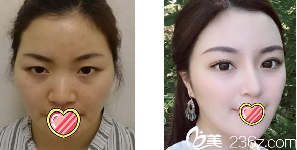 全切雙眼皮+去眼袋+鼻綜合隆鼻6個(gè)月恢復(fù)效果