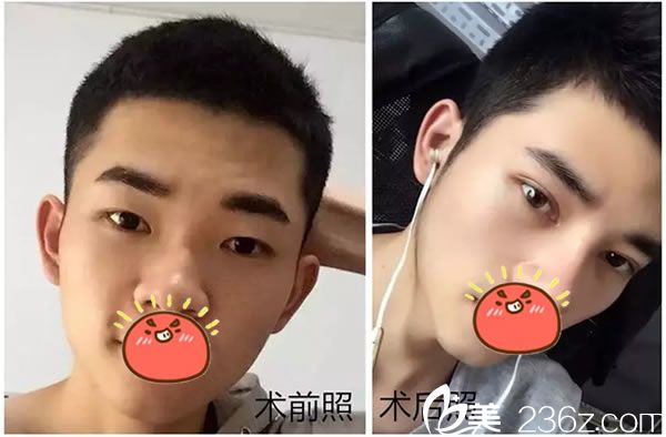 嘉興曙光阿爾法美眼案例效果