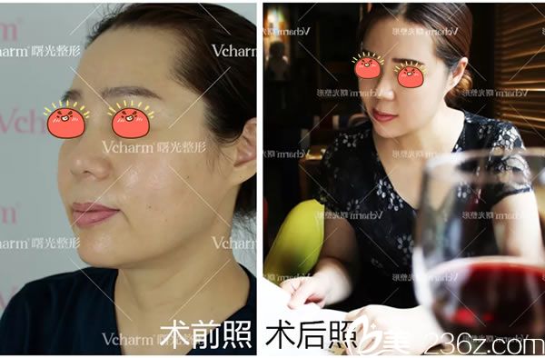 嘉興曙光4D線雕提拉逆齡案例效果