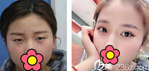 酒泉華美申志勇全切雙眼皮+開眼角效果案例