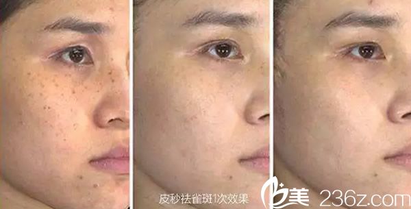 酒泉華美皮秒激光祛斑效果案例