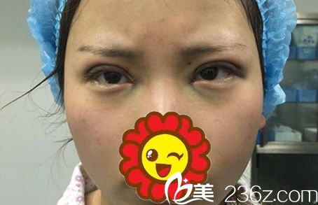 全切雙眼皮+開眼角天